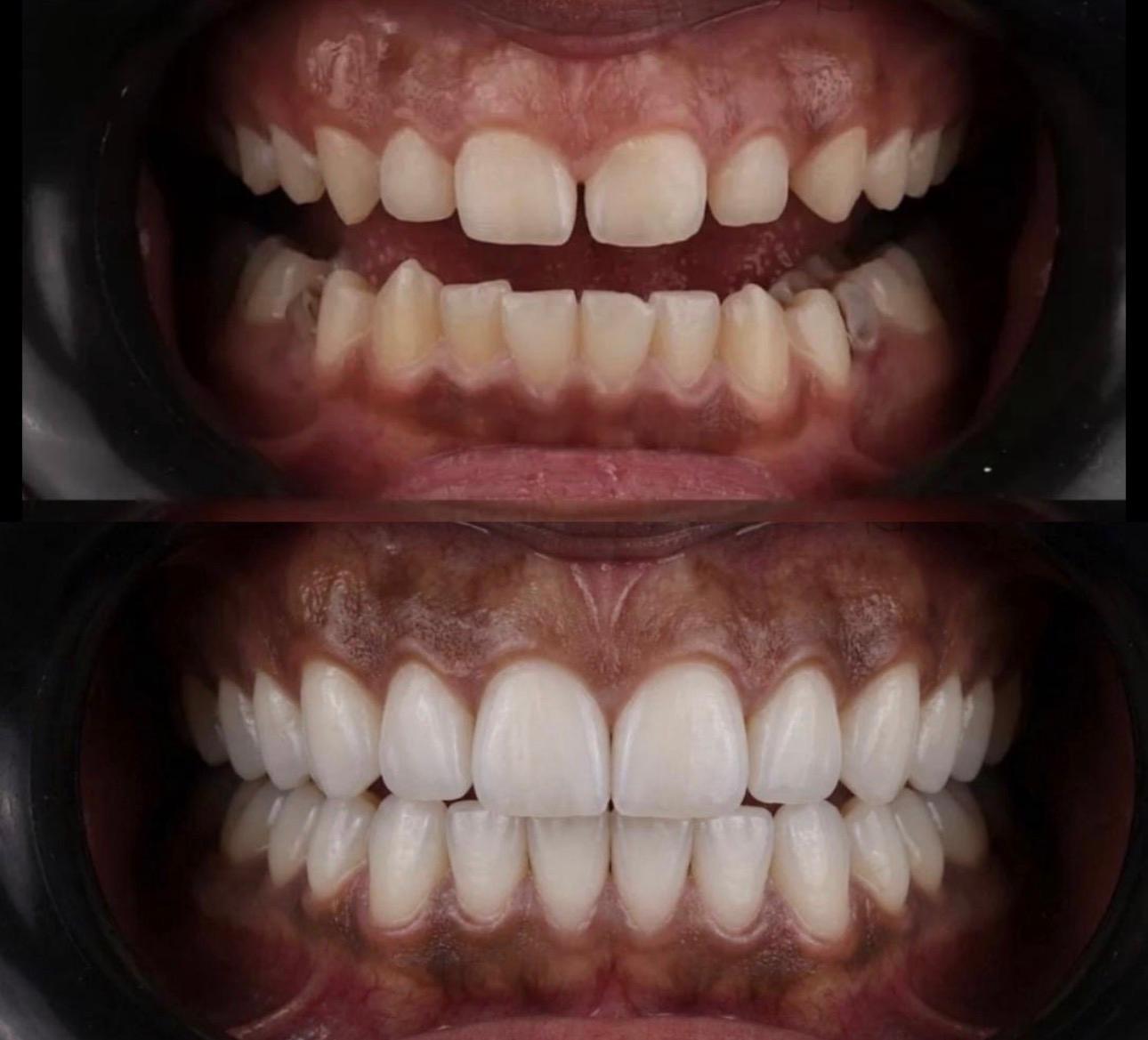 Hasta gülüş dönüşümü 3