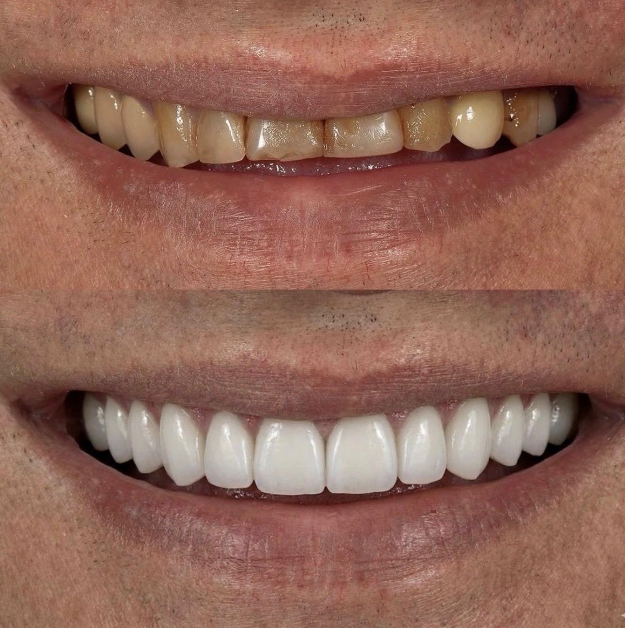 Hasta gülüş dönüşümü 9