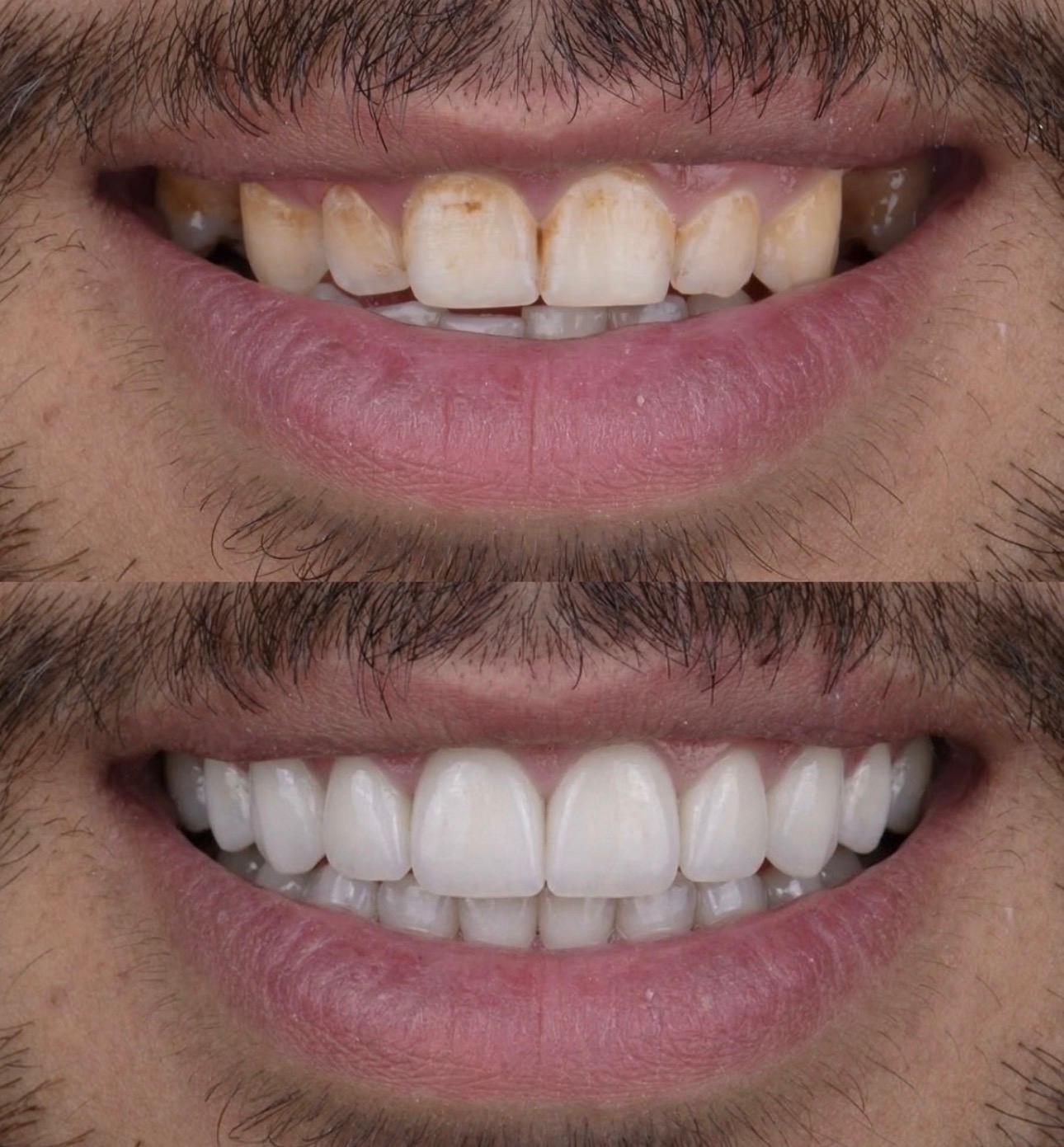 Hasta gülüş dönüşümü 20