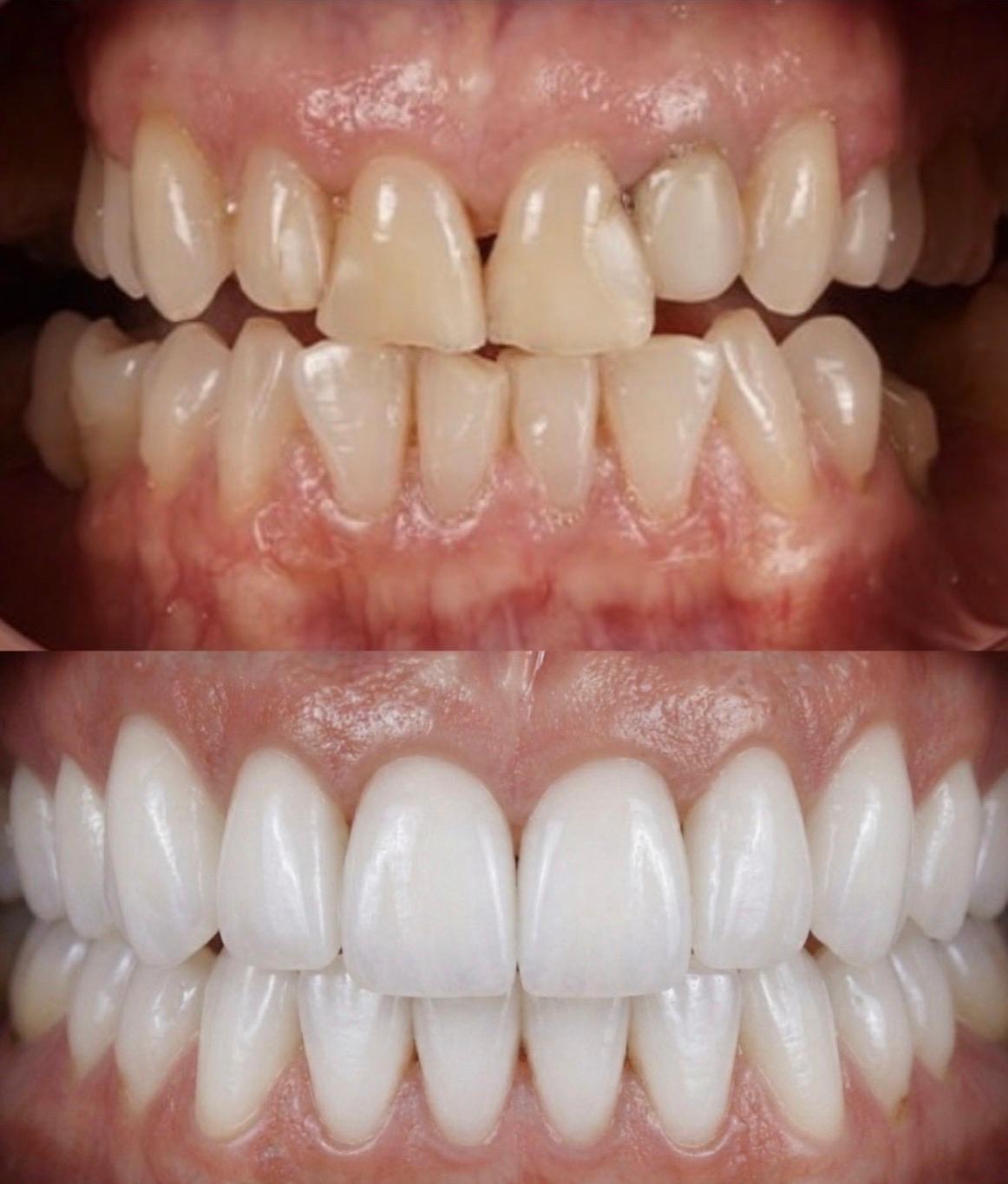 Hasta gülüş dönüşümü 25