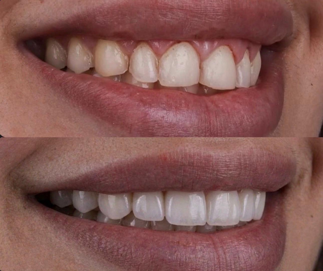 Hasta gülüş dönüşümü 29