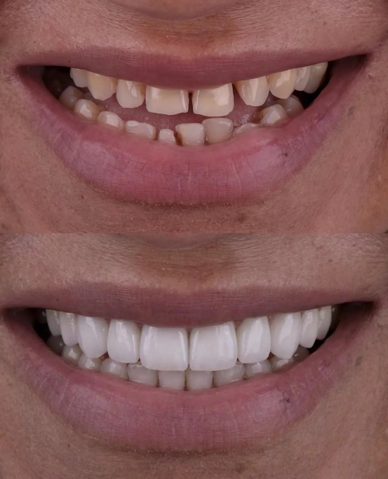 Porselen Lamina (Veneer)