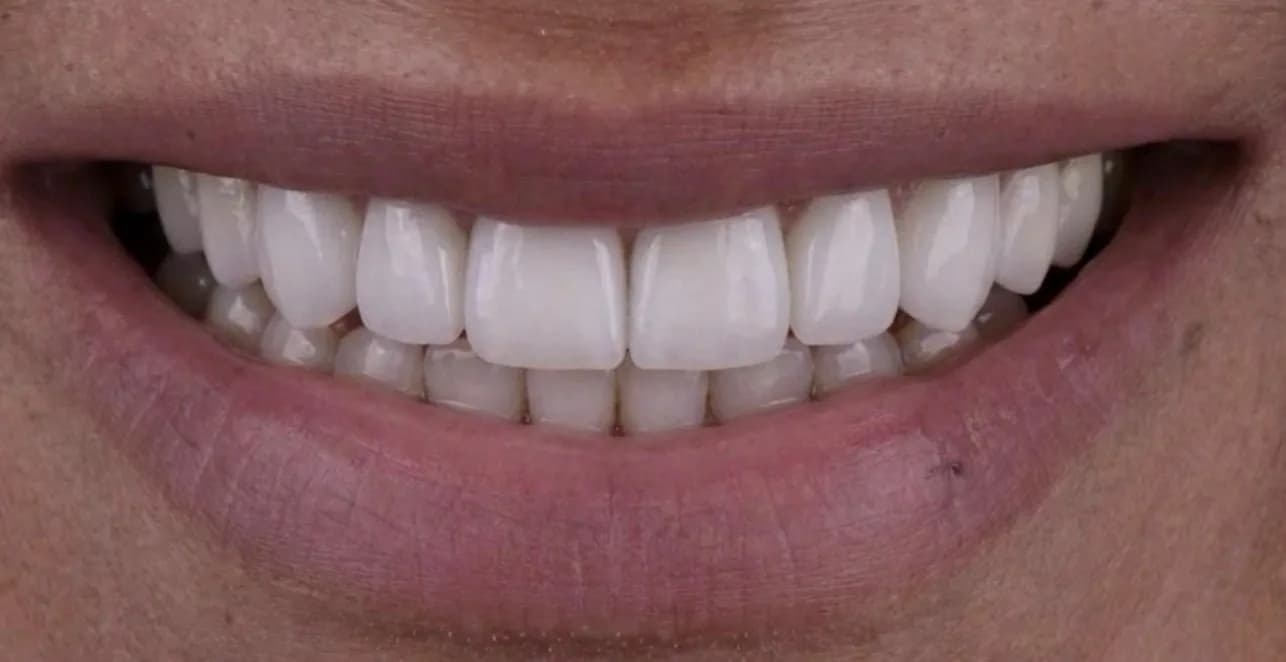 Porselen Lamina (Veneer)
