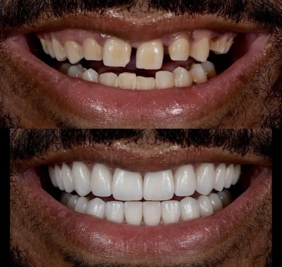 Gülüş Tasarımı — Hasta gülüş dönüşümü 20