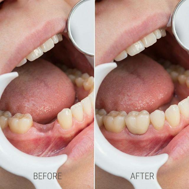 İmplant Tedavisi Öncesi ve Sonrası